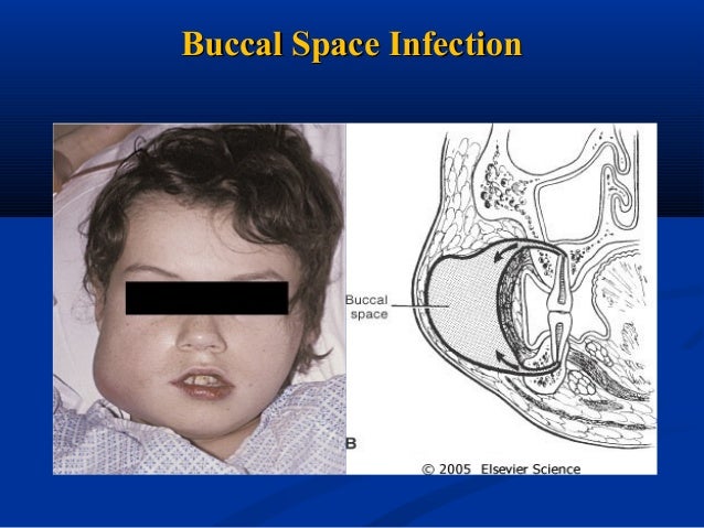 pdf treatment facial spaces infection Sexy index of jpg